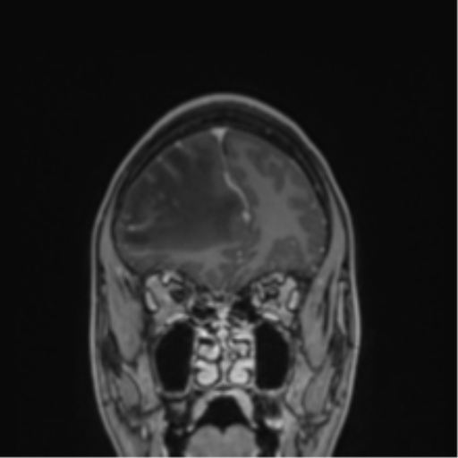 Cerebral abscess (Radiopaedia 60342-68009 H 43).png