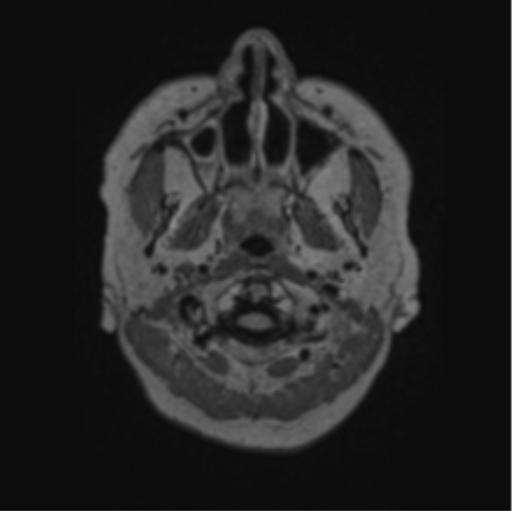 Cerebral abscess from pulmonary arteriovenous malformation (Radiopaedia 86275-102291 J 3).png