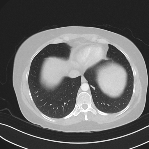 Cerebral abscess from pulmonary arteriovenous malformation (Radiopaedia 86275-102292 Axial lung window 46).png