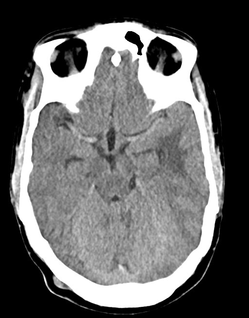 Cerebral abscesses (Radiopaedia 70458-80568 Axial non-contrast 25).jpg