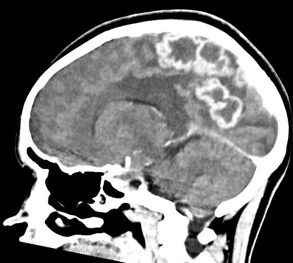 Cerebral abscesses (Radiopaedia 70458-80568 Sagittal Contrast 26).jpg