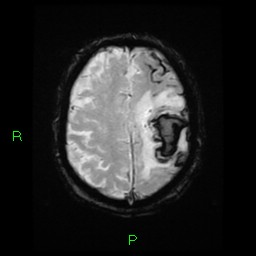 File:Cerebral amyloid angiopathy-associated lobar intracerebral hemorrhage (Radiopaedia 58376-65512 Axial Gradient Echo 7).jpg