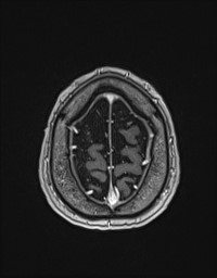 Cerebral amyloid angiopathy-related inflammation (Radiopaedia 58270-65377 Axial T1 C+ fat sat 136).jpg