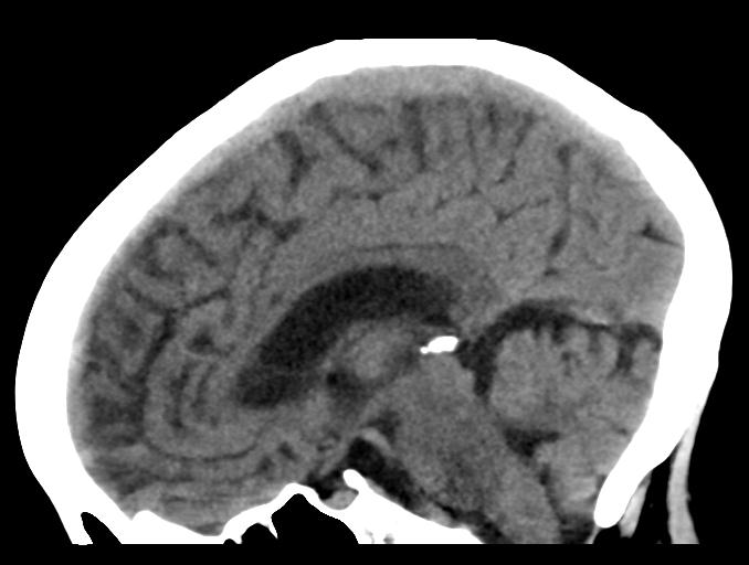 File:Cerebral aneurysm with rupture (Radiopaedia 29933-30457 B 15).jpg