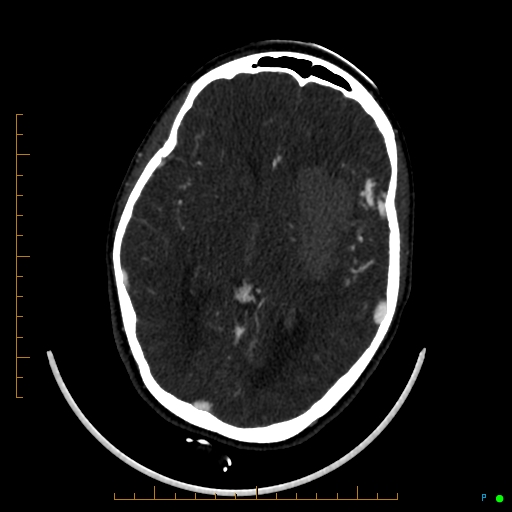 Cerebral arteriovenous malformation (AVM) (Radiopaedia 78162-90706 Axial CTA 139).jpg