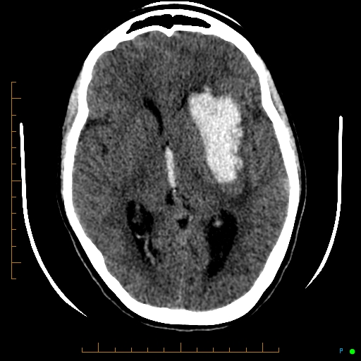 Cerebral arteriovenous malformation (AVM) (Radiopaedia 78162-90706 Axial non-contrast 32).jpg