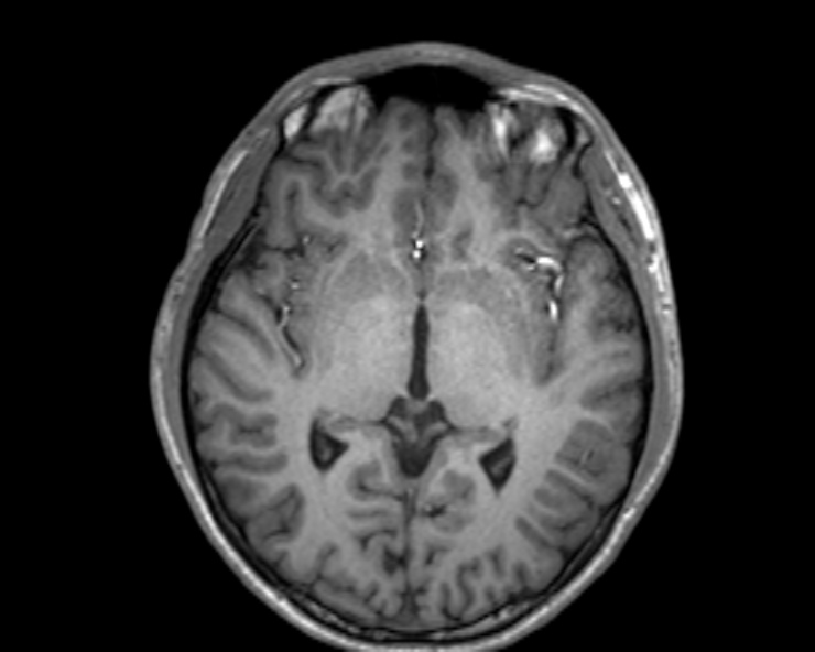 Cerebral arteriovenous malformation (Radiopaedia 30198-30813 Axial T1 34).jpg
