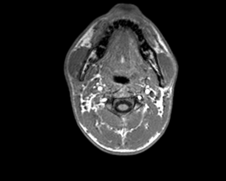 Cerebral arteriovenous malformation (Radiopaedia 30198-30813 Axial T1 60).jpg