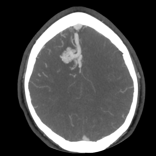 Cerebral arteriovenous malformation (Radiopaedia 39259-41505 AX CEREBRAL CTA 42).png