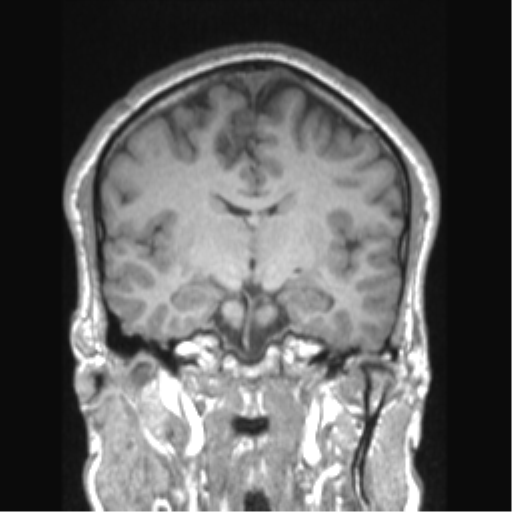 Cerebral arteriovenous malformation (Radiopaedia 39259-41506 Coronal T1 49).png