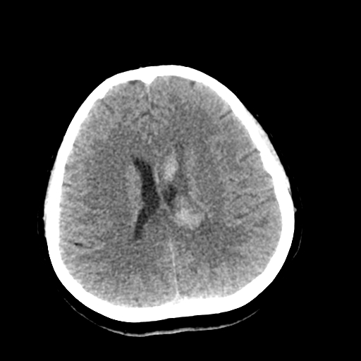 File:Cerebral arteriovenous malformation (Radiopaedia 73830-84645 Axial non-contrast 29).jpg