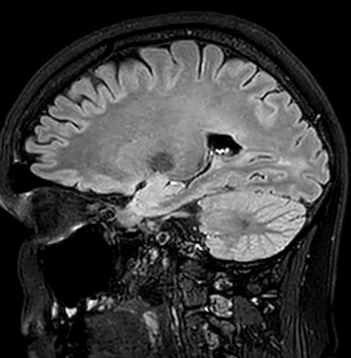 File:Cerebral arteriovenous malformation (Radiopaedia 74411-85746 Sagittal FLAIR 39).jpg