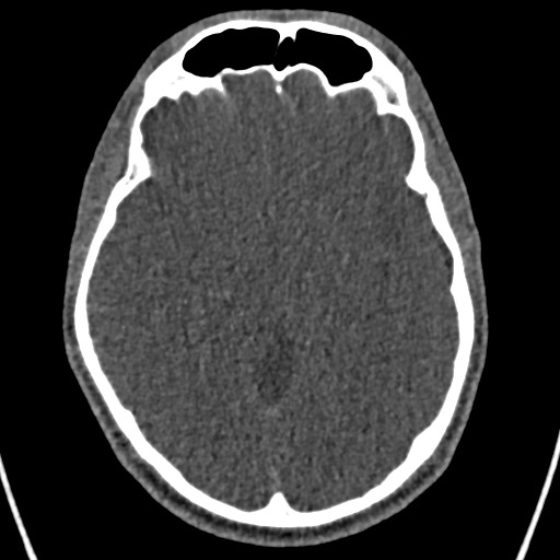 Cerebral arteriovenous malformation (Radiopaedia 78188-90746 Axial non-contrast 79).jpg