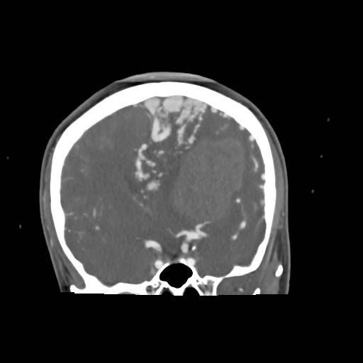 File:Cerebral arteriovenous malformation (Radiopaedia 79677-92888 B 15).jpg
