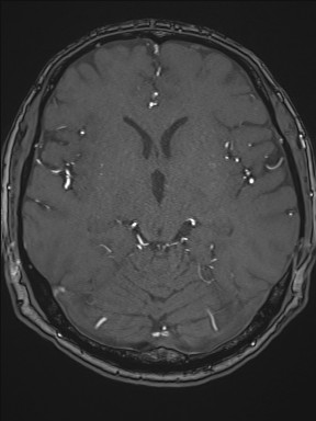 Cerebral arteriovenous malformation (Radiopaedia 84015-99245 Axial TOF 117).jpg