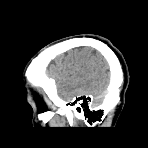 Cerebral arteriovenous malformation (Spetzler-Martin grade 2) (Radiopaedia 41262-44076 A 14).png