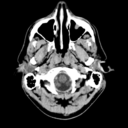 File:Cerebral arteriovenous malformation (Spetzler-Martin grade 2) (Radiopaedia 41262-44076 Axial non-contrast 7).png