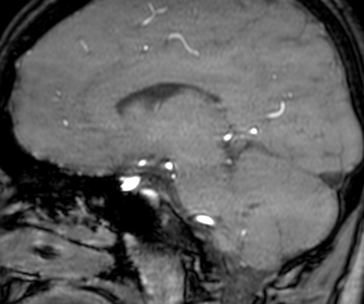 Cerebral arteriovenous malformation at posterior body of corpus callosum (Radiopaedia 74111-84925 J 220).jpg
