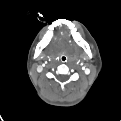Cerebral arteriovenous malformation with hemorrhage (Radiopaedia 28773-29073 A 66).jpg