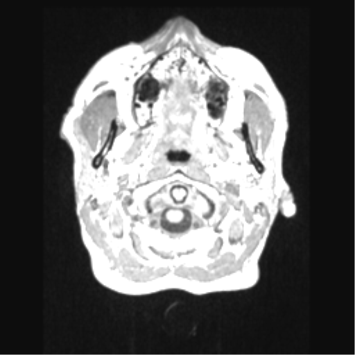 File:Cerebral arteriovenous malformation with hemorrhage (Radiopaedia 34422-35737 Axial T1 2).png
