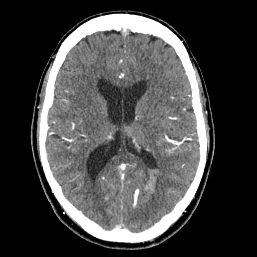 Cerebral arteriovenous malformation with lobar hemorrhage (Radiopaedia 35598-57216 A 35).jpg
