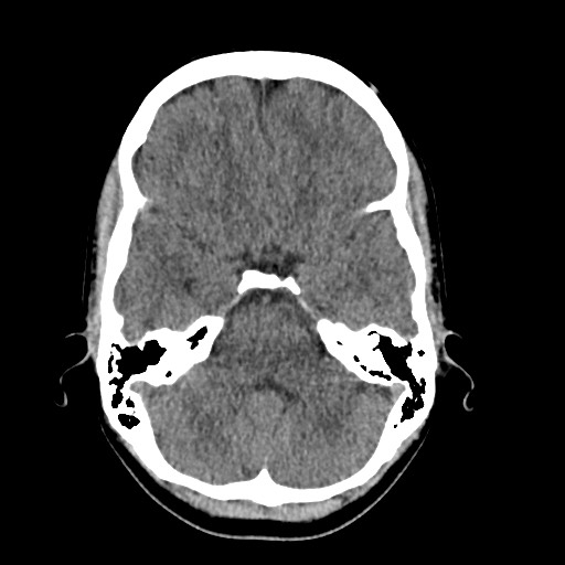 Cerebral cavernous venous malformation (Radiopaedia 70008-80022 Axial non-contrast 13).jpg