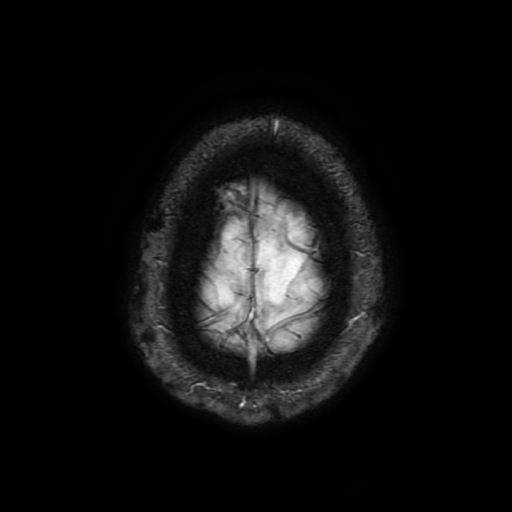 File:Cerebral cavernous venous malformation (Zabramski type II) (Radiopaedia 85511-101198 Axial SWI 108).jpg