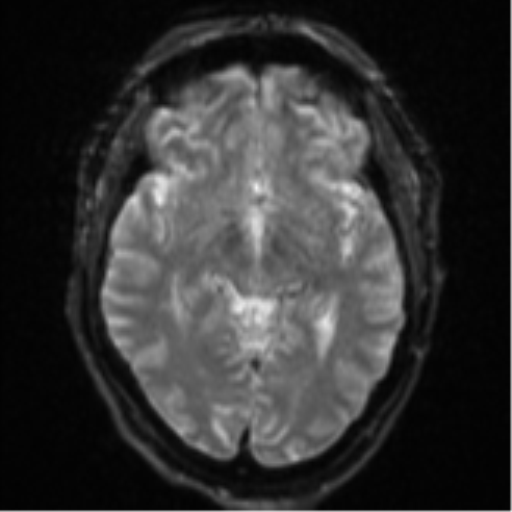 File:Cerebral embolic infarcts (embolic shower) (Radiopaedia 57395-64342 Axial DWI 16).png