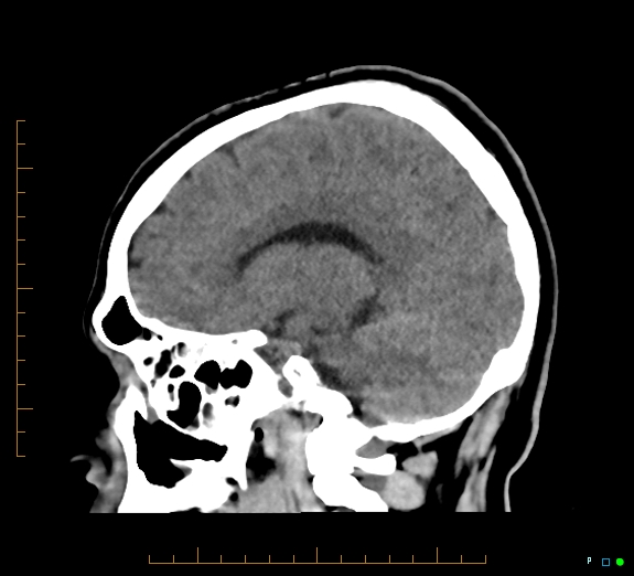 Cerebral fat embolism (Radiopaedia 85521-101220 B 24).jpg