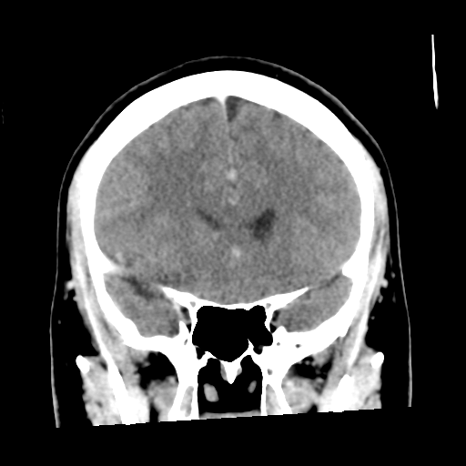 Cerebral hemorrhage secondary to arteriovenous malformation (Radiopaedia 33497-34561 C 23).png
