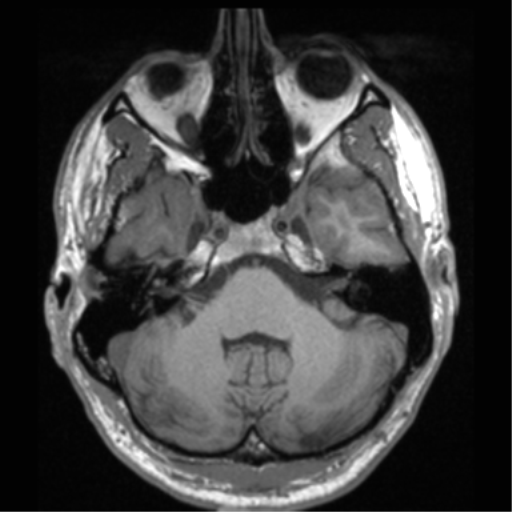 Cerebral hemorrhagic contusions- temporal evolution (Radiopaedia 40224-42757 Axial T1 19).png