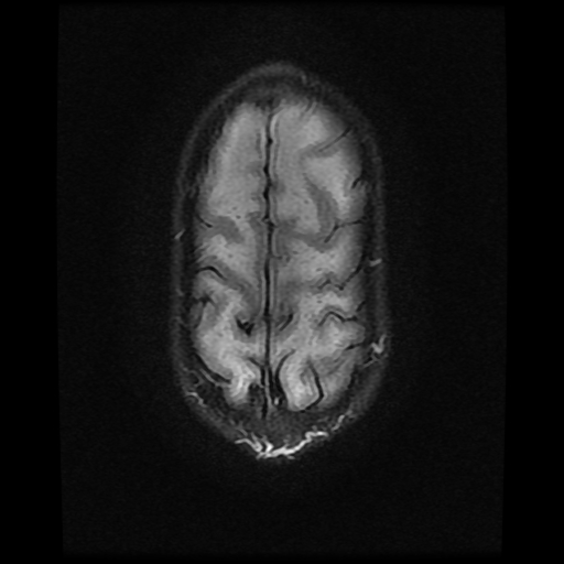 File:Cerebral manifestations of mucopolysaccharidosis type I (Radiopaedia 59171-66487 Axial FLAIR 19).jpg