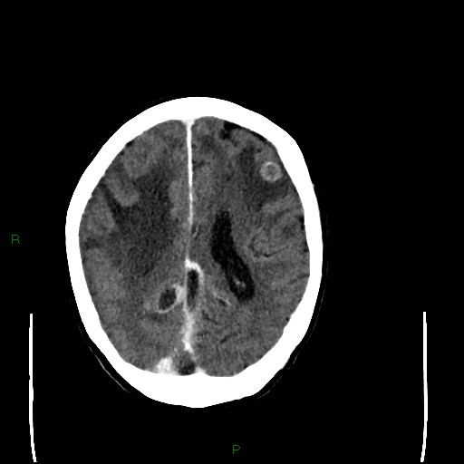 Cerebral metastases - breast primary (Radiopaedia 77653-89857 Axial C+ delayed 75).jpg