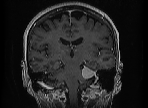 Cerebral metastases from lung cancer with amyloid angiopathy and cerebellopontine angle meningioma (Radiopaedia 74306-85191 Coronal T1 C+ 34).jpg