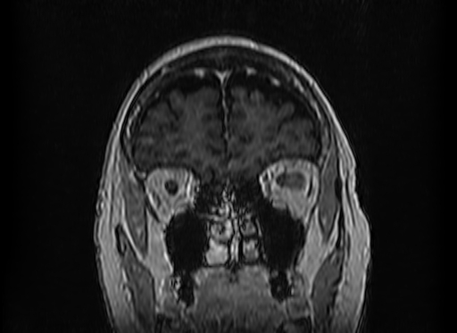 Cerebral metastases from lung cancer with amyloid angiopathy and cerebellopontine angle meningioma (Radiopaedia 74306-85191 Coronal T1 C+ 9).jpg