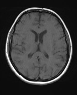 File:Cerebral metastases mimicking abscesses (Radiopaedia 45841-50131 Axial T1 17).png