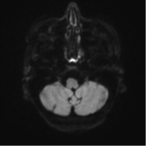 Cerebral metastasis (Radiopaedia 46744-51248 Axial DWI 33).png
