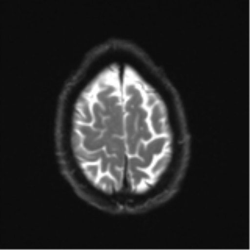 Cerebral metastasis - melanoma (Radiopaedia 54718-60954 Axial DWI 26).png