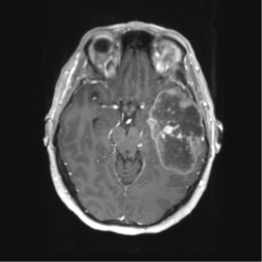 Cerebral metastasis mimicking glioblastoma (Radiopaedia 69155-78937 Axial T1 C+ 23).png