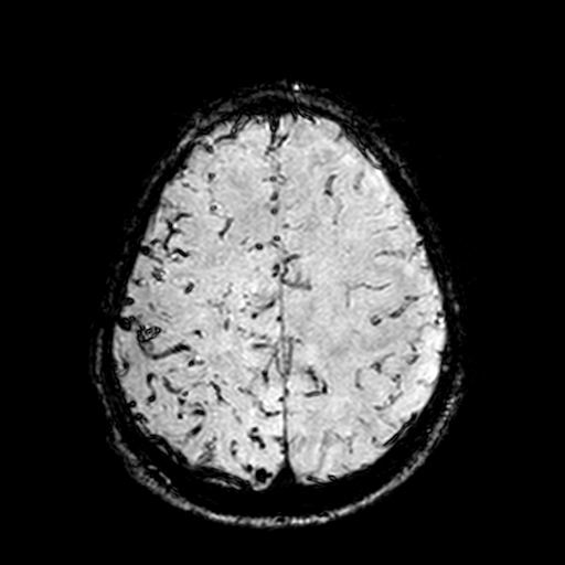 Cerebral parenchymal arteriovenous malformation (Radiopaedia 27280-27456 Axial SWI 94).jpg