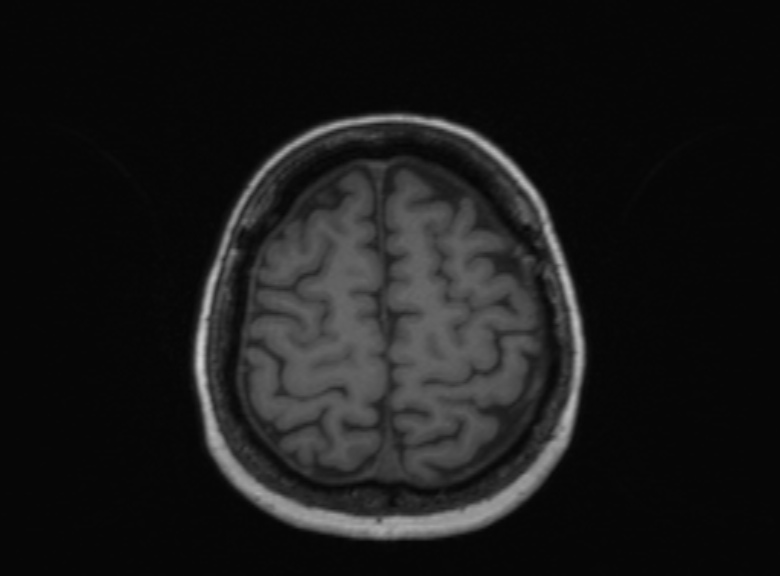 Cerebral ring enhancing lesions - cerebral metastases (Radiopaedia 44922-48817 Axial T1 138).jpg