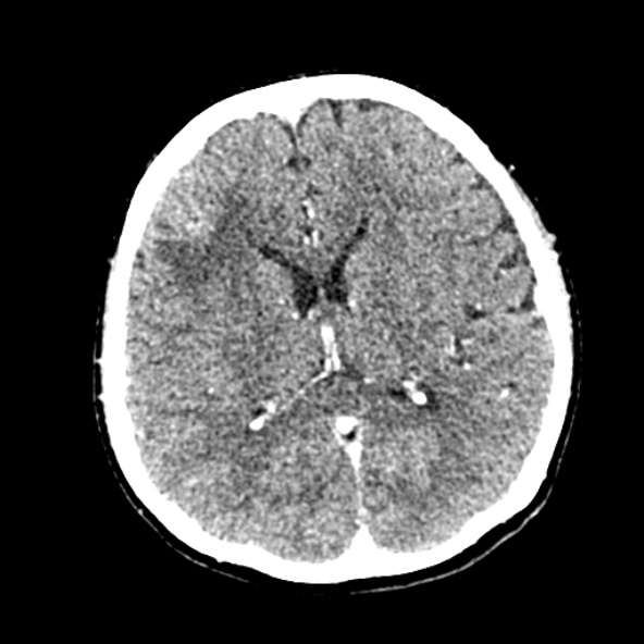 Cerebral ring enhancing lesions - cerebral metastases (Radiopaedia 44922-48818 B 163).jpg
