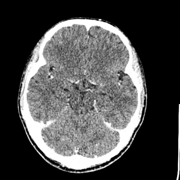 File:Cerebral toxoplasmosis (Radiopaedia 53993-60131 Axial C+ delayed 28).jpg