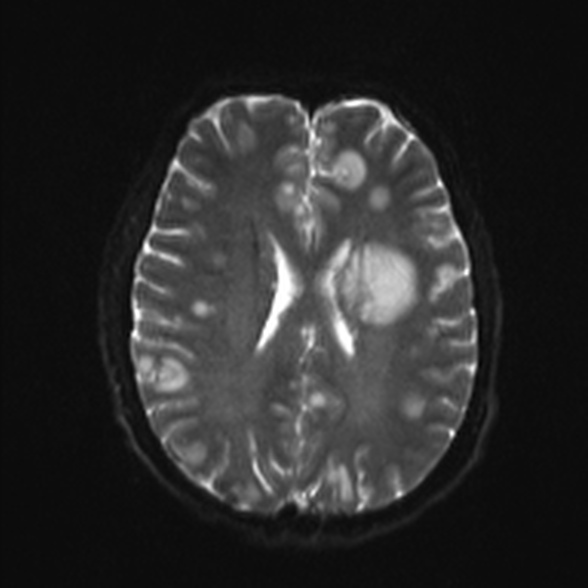 Cerebral toxoplasmosis (Radiopaedia 53993-60132 Axial DWI 17).jpg