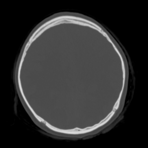 Cerebral tuberculosis with dural sinus invasion (Radiopaedia 60353-68018 Axial bone window 39).jpg