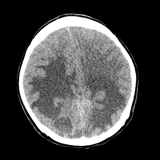 Cerebral tuberculosis with dural sinus invasion (Radiopaedia 60353-68018 Axial non-contrast 39).jpg