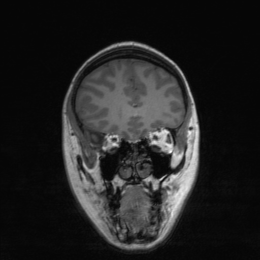 File:Cerebral tuberculosis with dural sinus invasion (Radiopaedia 60353-68090 Coronal T1 54).jpg