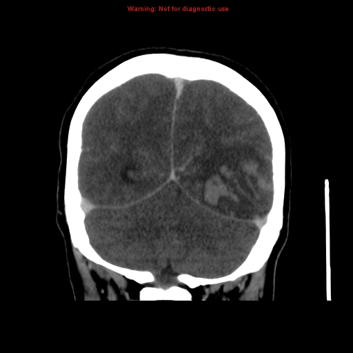 Cerebral venous infarction (Radiopaedia 12404-20735 B 63).jpg