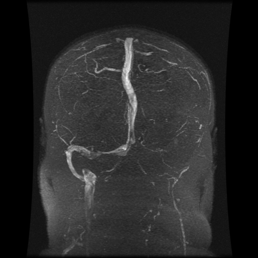 Cerebral venous infarction (Radiopaedia 25109-25396 MRV 1).jpg