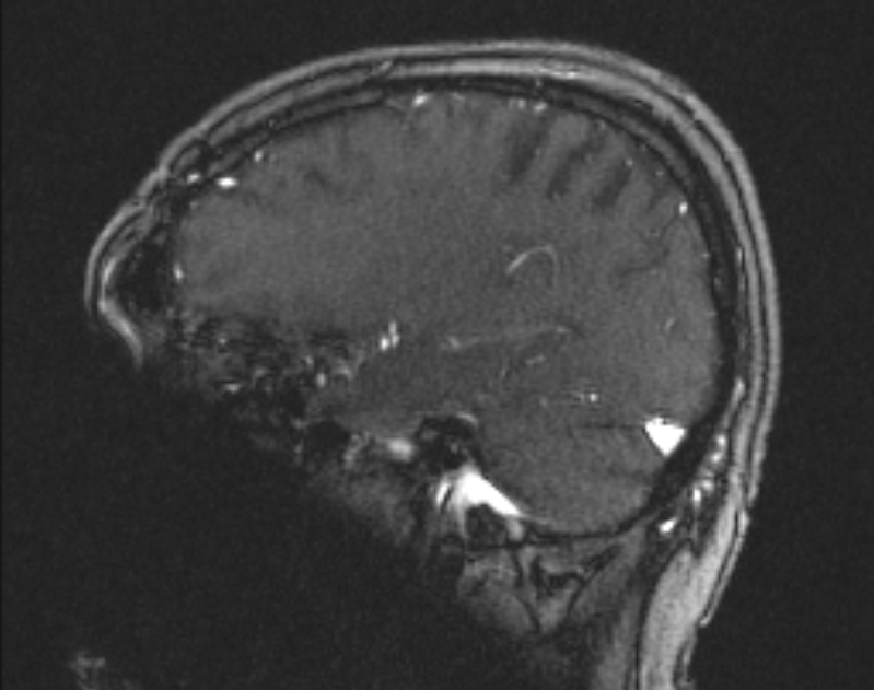 Cerebral venous infarction (Radiopaedia 65166-74176 Sagittal TOF 51).jpg